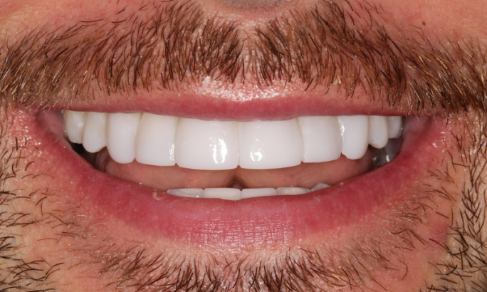 Case 1 after After - Sky Dental