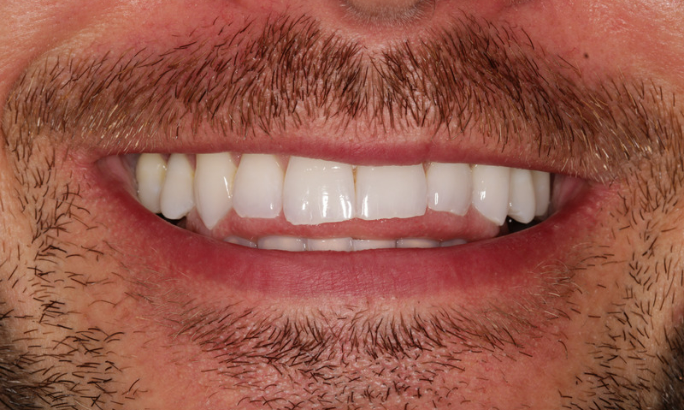 Case 1 before Before - Sky Dental