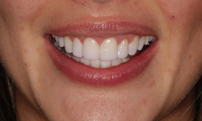 After - Sky Dental 