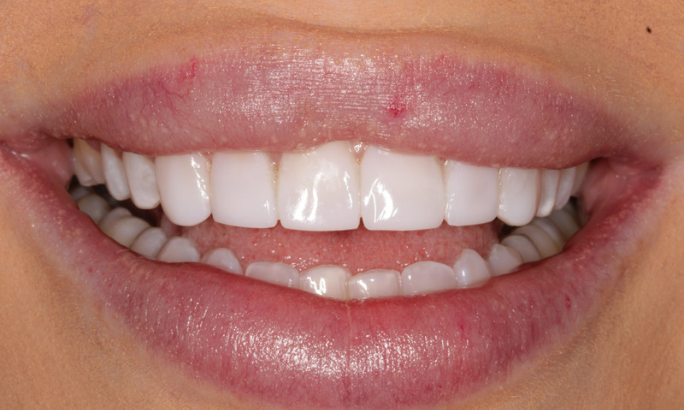 Case 3 after After - Sky Dental