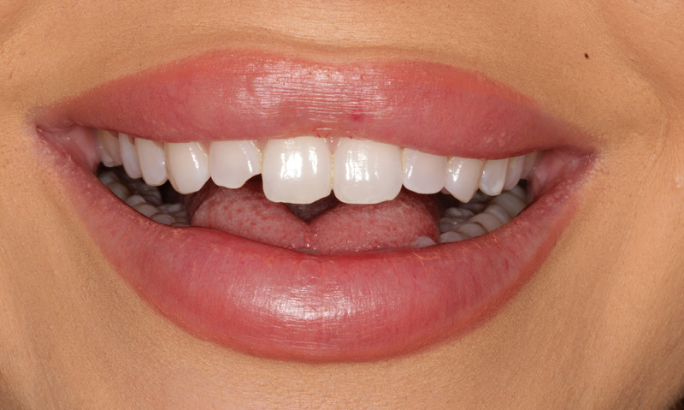 Case 3 before Before - Sky Dental