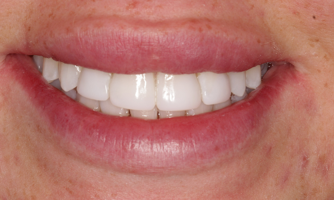 Case 4 after After - Sky Dental