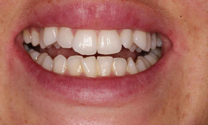Case 4 before Before - Sky Dental